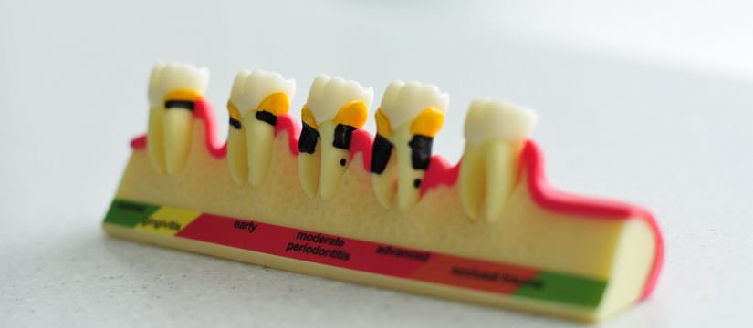 parodontiit