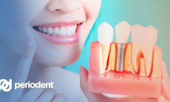 hambaimplantaat - mis see on ja kuidas hambaimplantaadi paigaldamine toimub