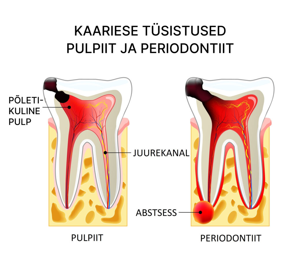 juureravi näidustused - pulpiit ja periodontiit
